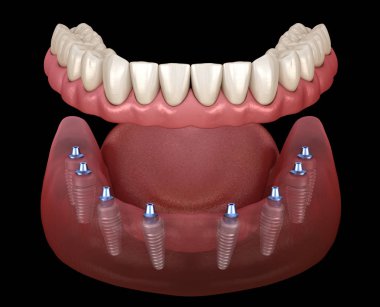 Mandibular protez Tüm 8 sistemi implantlar tarafından desteklenir. İnsan dişleri ve protezkavramının tıbbi olarak doğru 3d illüstrasyon