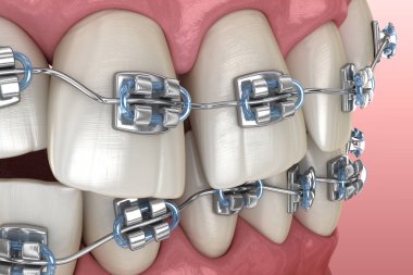 Anormal diş pozisyonu ve metal parantez tretament. Tıbbi olarak doğru diş 3d illüstrasyon