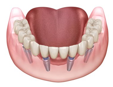 Alt çene protezi. Hepsi de implantlarla desteklenen 4 sistemde. İnsan dişleri ve protez kavramının tıbben doğru üç boyutlu çizimi