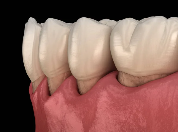 Gum recession process. Medically accurate 3D illustration