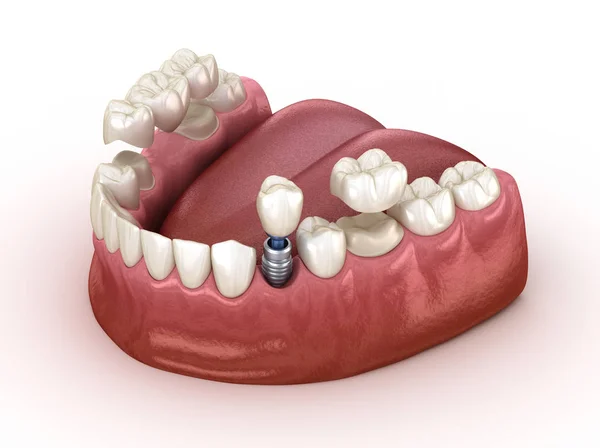 Восстановление Зубов Помощью Имплантата Коронки Медицинская Точность Трехмерной Иллюстрации — стоковое фото