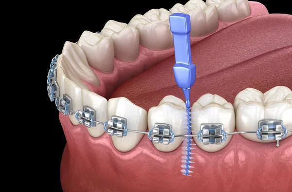 Interdental tooth brush and braces cleaning. Medically accurate 3D illustration of oral hygiene.