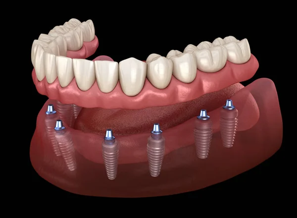 Prothèse Mandibulaire Tout Sur Système Soutenu Par Des Implants Illustration — Photo