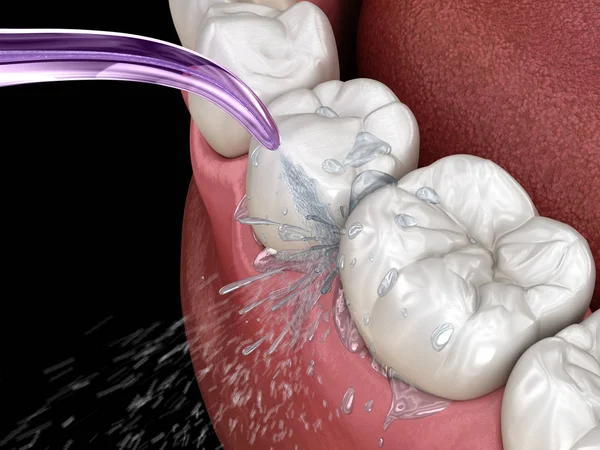 Irrigatore Pulizia Dei Denti Acqua Illustrazione Clinicamente Accurata Dell Igiene — Foto Stock