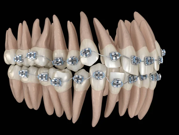 Dentes Anormais Posição Metal Aparelho Tretamento Ilustração Odontológica Medicamente Precisa — Fotografia de Stock