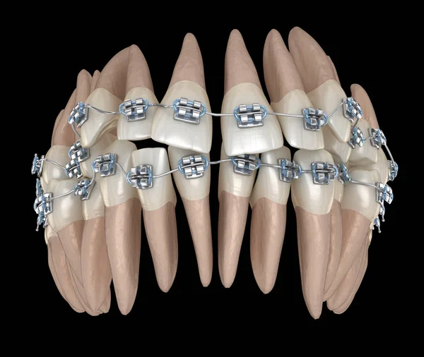 Nieprawidłowa Pozycja Zębów Metalowe Szelki Tretament Medycznie Dokładna Ilustracja Stomatologicznych — Zdjęcie stockowe