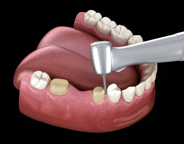 歯科用クラウン配置のための予備準備プロセス 医学的に正確な3Dイラスト — ストック写真