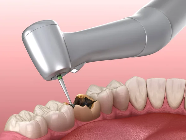 去龋的过程 医学上准确的牙齿3D图像 — 图库照片