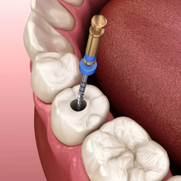 牙内根管治疗过程 医学上准确的牙齿3D图像 — 图库照片