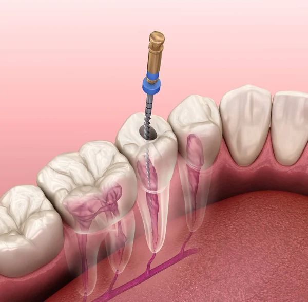 Proces Leczenia Kanałowego Endodontycznego Medycznie Dokładna Ilustracja Zęba — Zdjęcie stockowe