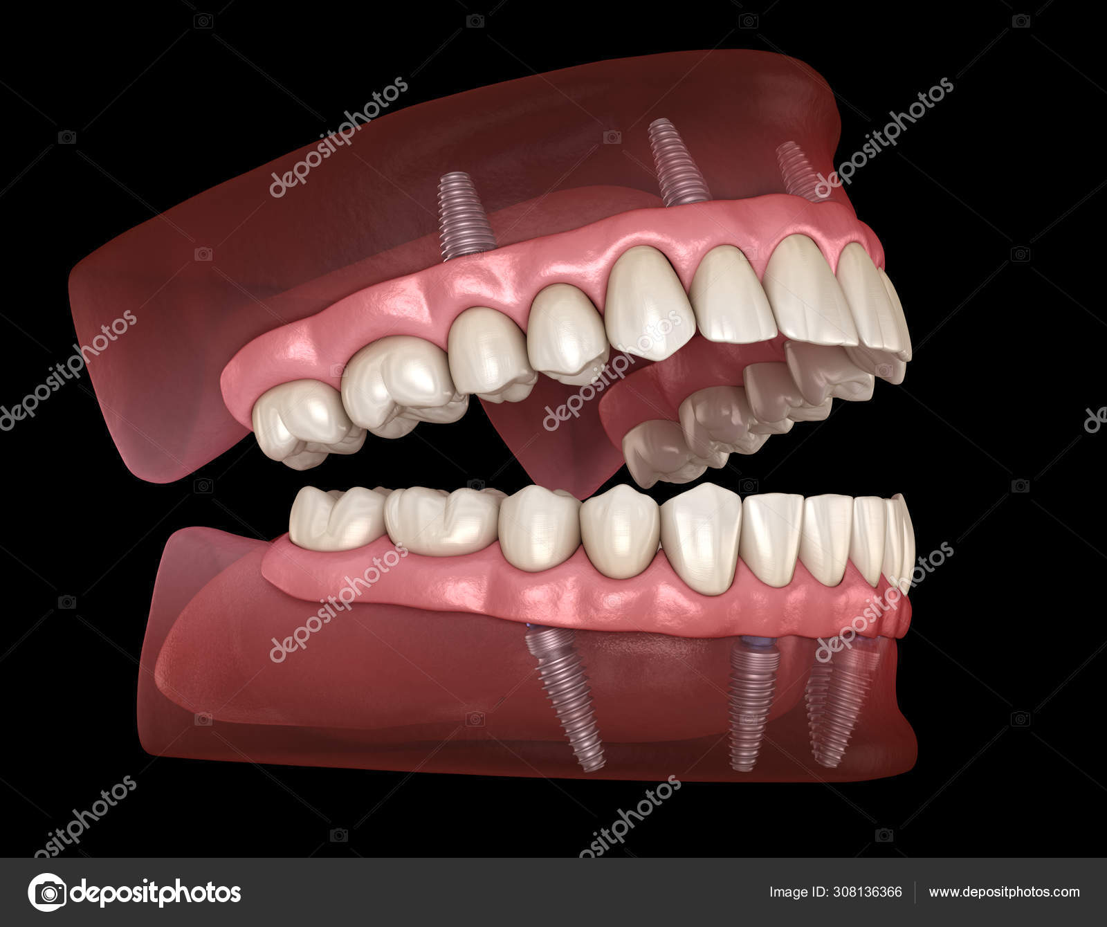 Prótese Mandibular Maxilar Tudo Sobre Sistema Suportado Por, mandibula e  maxilar 