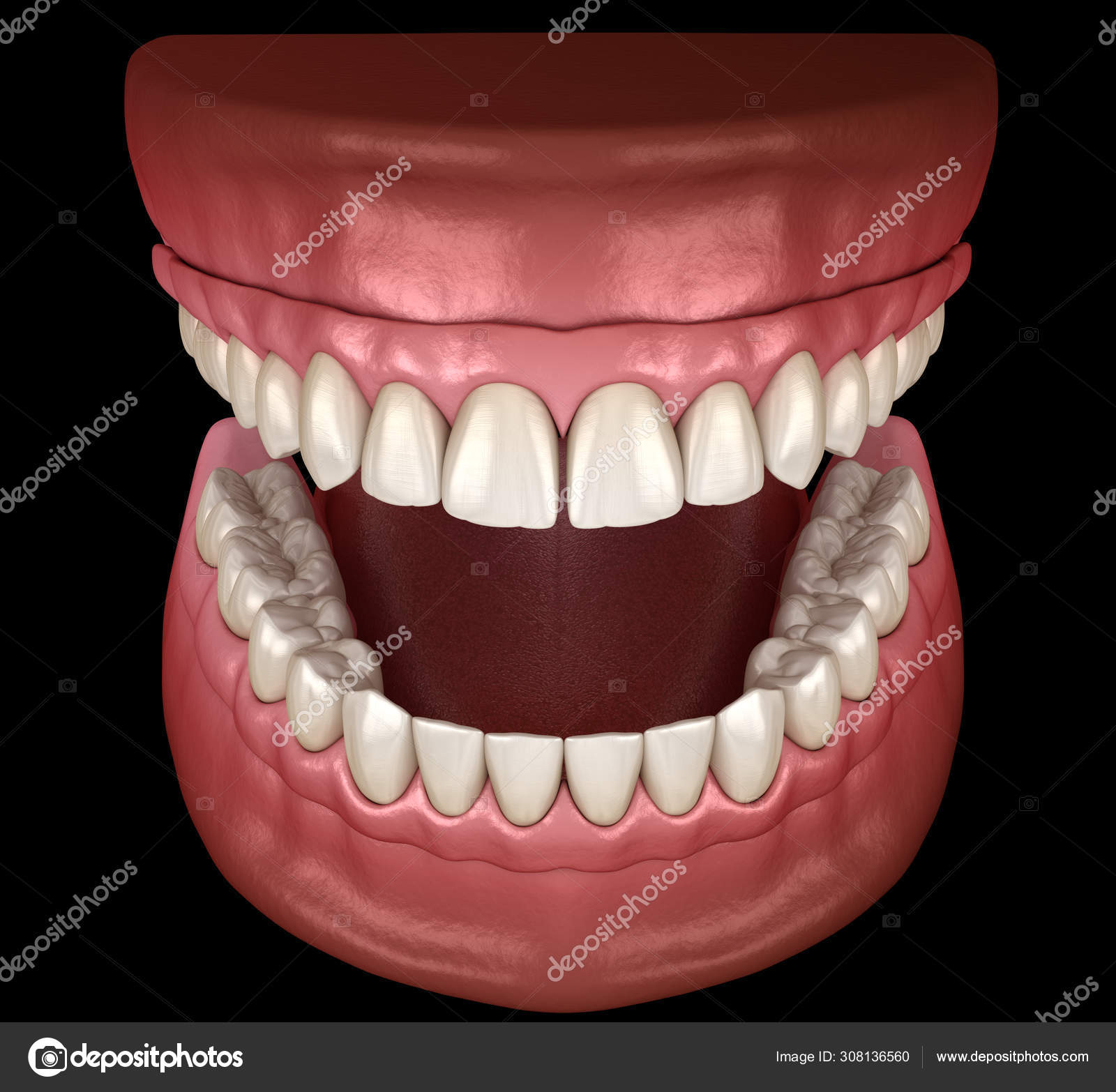 Prótese Mandibular Maxilar Tudo Sobre Sistema Suportado Por