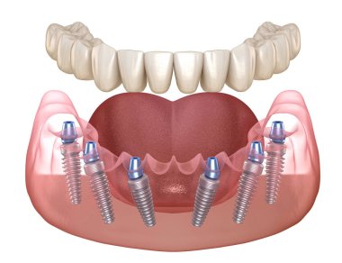 Çene protezi. Hepsi de implantlarla desteklenen 6 sistemde. İnsan dişleri ve protez kavramının tıbben doğru üç boyutlu çizimi