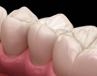 Dolgu ile premolar diş restorasyonu. Tıbbi olarak doğru diş 3d illüstrasyon.
