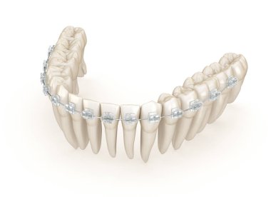 Teeth and Clear braces. 3D illustration concept clipart
