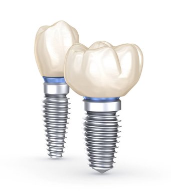 Diş implantları. İnsan dişlerinin 3 boyutlu illüstrasyon kavramı