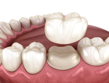 Diş kaplaması yerleştirme için hazırlanmış azı dişi. Tıbbi olarak doğru 3B illüstrasyon