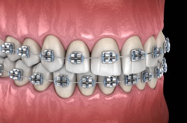 Metal parantez ile Sağlıklı Dişler. Tıbbi olarak doğru diş 3d illüstrasyon