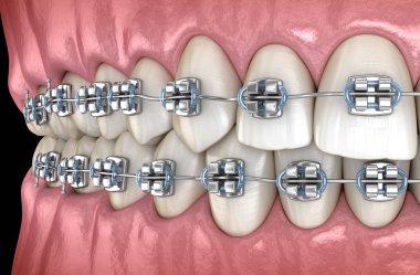 Metal parantez ile Sağlıklı Dişler. Tıbbi olarak doğru diş 3d illüstrasyon