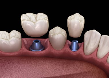 Premolar ve Molar diş taç implant üzerine kurulum - kavram. İnsan dişleri ve protezleri 3d illüstrasyon