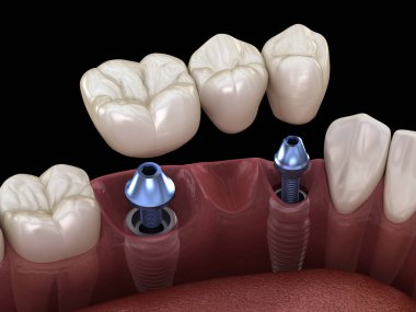 Diş köprüsü implantlarla destekleniyor. İnsan dişleri ve protez kavramının tıbben doğru üç boyutlu çizimi