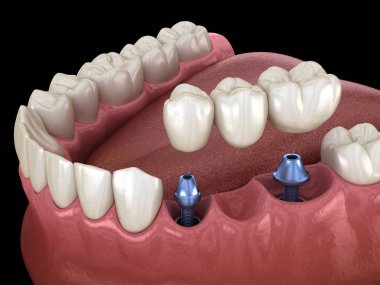 Diş köprüsü implantlarla destekleniyor. İnsan dişleri ve protez kavramının tıbben doğru üç boyutlu çizimi