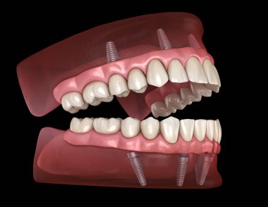 Maxillary and Mandibular prosthesis with gum All on 4 system supported by implants. Medically accurate 3D illustration of human teeth and dentures clipart