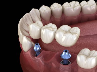 Diş köprüsü implantlarla destekleniyor. İnsan dişleri ve protez kavramının tıbben doğru üç boyutlu çizimi