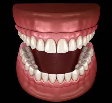 Çikletli Maxillary ve Mandibular protez hepsi de implantlarla desteklenen 4 sistemde. İnsan dişlerinin ve protezlerinin tıbbi açıdan doğru üç boyutlu çizimi
