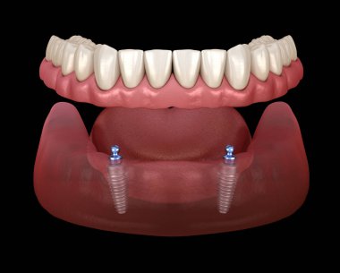 Alt çene çıkarılabilir protez. Hepsi top eklentili implantlar tarafından desteklenen 2 sistemde. Tıbbi olarak doğru olan 3 boyutlu diş illüstrasyonu