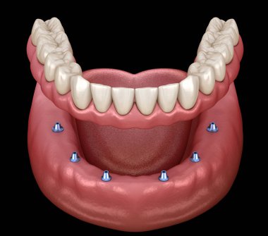 Çikletli çene protezi. Hepsi de implantlarla desteklenen 6 sistemde. İnsan dişleri ve protez kavramının tıbben doğru üç boyutlu çizimi