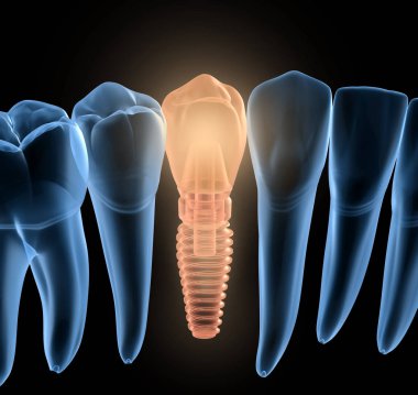 İmplant ile premolar diş kurtarma, x-Ray görünümü. İnsan dişleri ve protezkavramının tıbbi olarak doğru 3d illüstrasyon