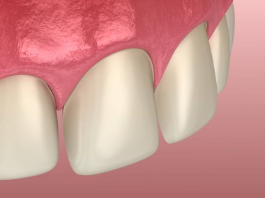 Merkezi kesici diş ve yanal kesici diş üzerinde Venedik kurulum prosedürü için diş hazırlığı. Tıbbi olarak doğru diş 3D illüstrasyon