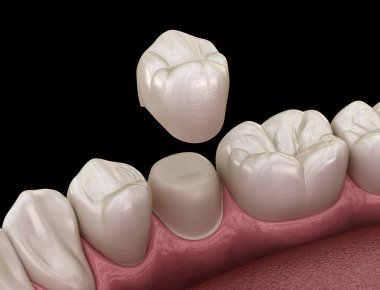 Diş taç yerleştirme için önceden paralanmış premolar diş. Tıbbi olarak doğru 3d illüstrasyon