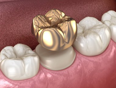 Golden crown molar tooth assembly process. Medically accurate 3D illustration of human teeth treatment clipart