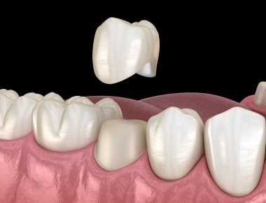 Diş taç yerleştirme için önceden paralanmış premolar diş. Tıbbi olarak doğru 3d illüstrasyon