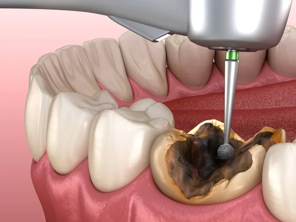 Kariesentfernungsprozess Medizinisch Korrekte Darstellung Der Zähne — Stockfoto