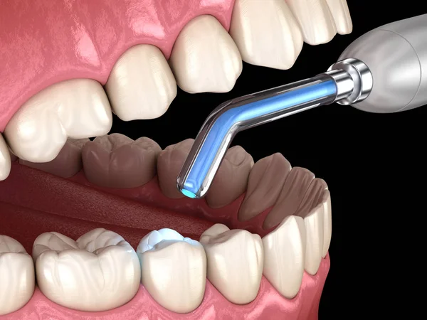 Zahnsanierung Mit Füllung Und Polymerisationslampe Medizinisch Korrekte Darstellung Der Zähne — Stockfoto
