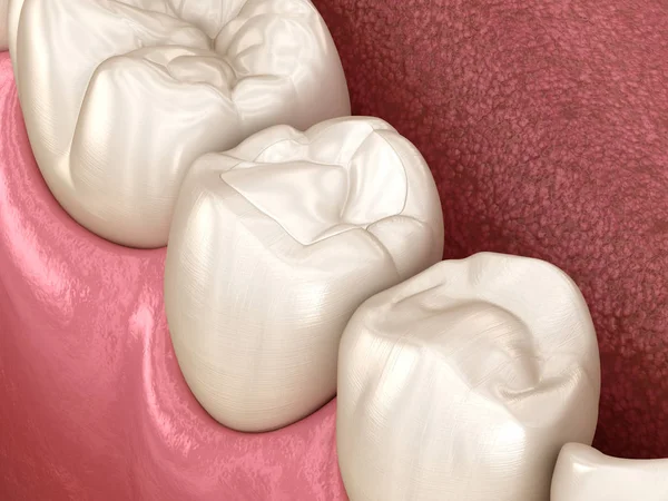 Pemulihan Gigi Premolar Dengan Pengisian Ilustrasi Gigi Yang Akurat Secara — Stok Foto