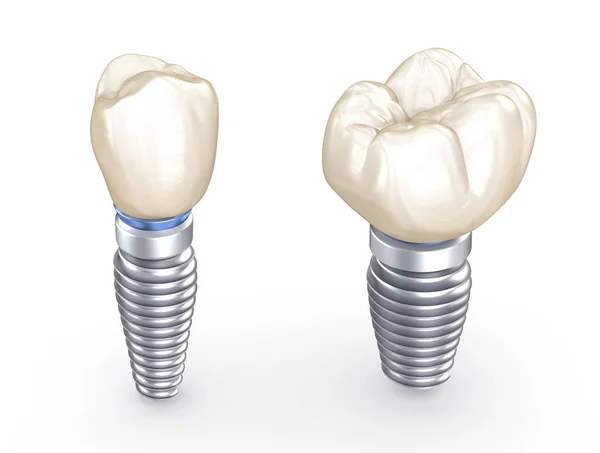 Implanty Dentystyczne Koncepcja Ilustracji Ludzkich Zębów — Zdjęcie stockowe