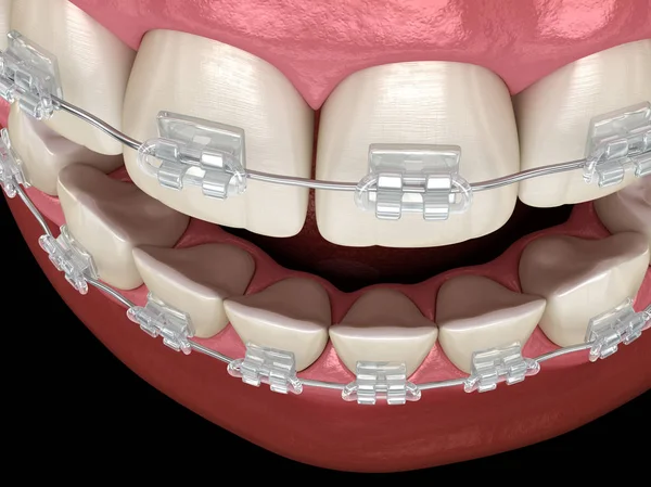 Denti Apparecchio Chiaro Illustrazione Dentale Clinicamente Accurata — Foto Stock