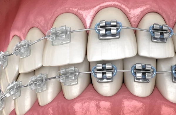 金属とクリアブレースを持つ歯 医学的に正確な歯科3Dイラスト — ストック写真