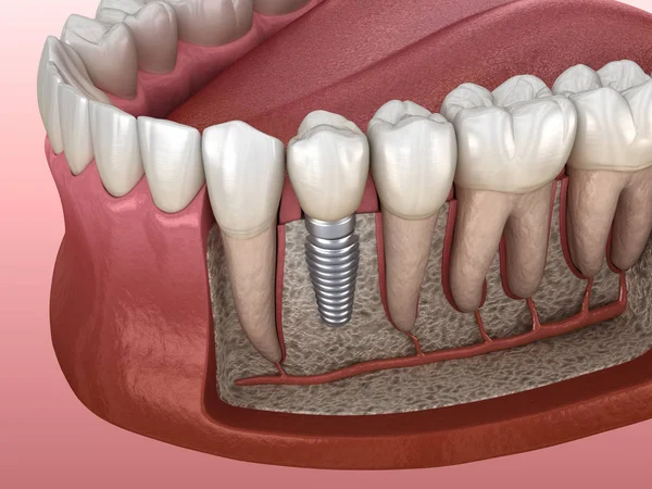 Premolär Tandåterhämtning Med Implantat Medicinskt Korrekt Illustration Mänskliga Tänder Och — Stockfoto