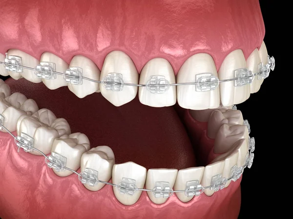 Denti Apparecchio Chiaro Illustrazione Dentale Clinicamente Accurata — Foto Stock