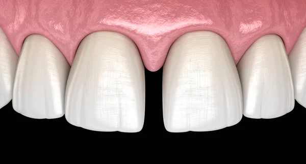 Діастема Зубів Центральних Різців Концепція Ілюстрації Стоматологічної Несправності — стокове фото