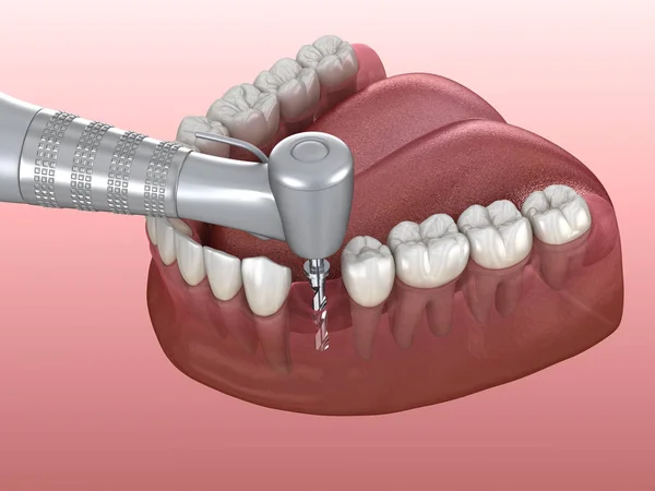 Diş Implantı Yerleştirilirken Kemiğin Delinmesi Nsan Dişleri Protez Kavramının Tıbben — Stok fotoğraf