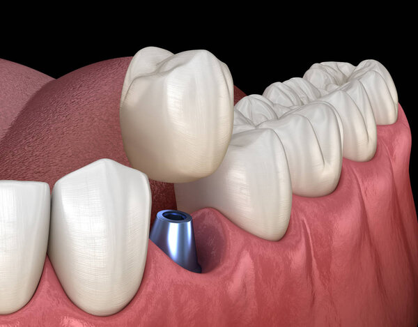 Premolar tooth recovery with implant. Medically accurate 3D illustration of human teeth and dentures concept