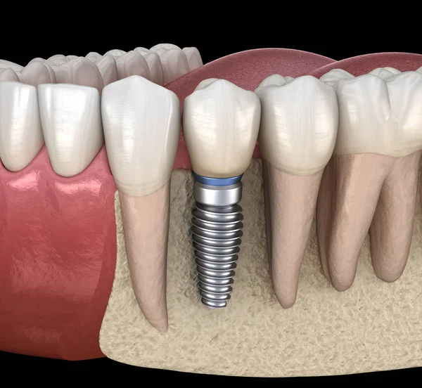 Implantátummal Helyreállt Fogszuvasodás Orvosilag Pontos Illusztráció Emberi Fogak Műfogsor Koncepció — Stock Fotó