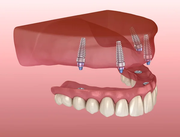 インプラントによってサポートされている4つのシステム上のすべてのガムと上顎の義肢 人間の歯と入れ歯の医学的に正確な3Dイラスト — ストック写真