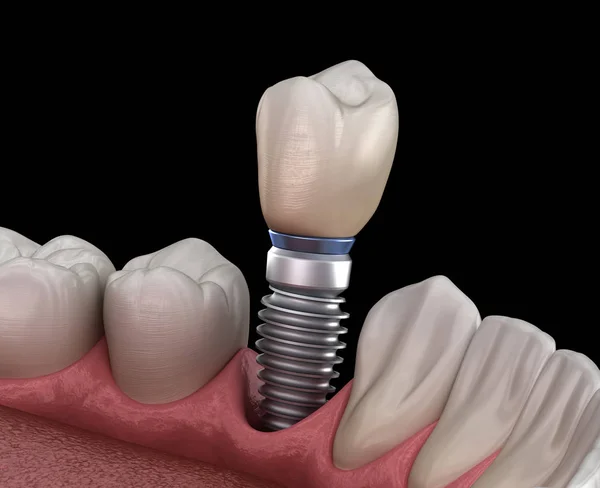 Відновлення Передпологових Зубів Допомогою Імплантату Медично Точна Ілюстрація Концепції Зубів — стокове фото